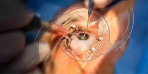 Cataract Surgery in Ropar – Know Your Lens Options & Pricing at Pannu Eye Hospital