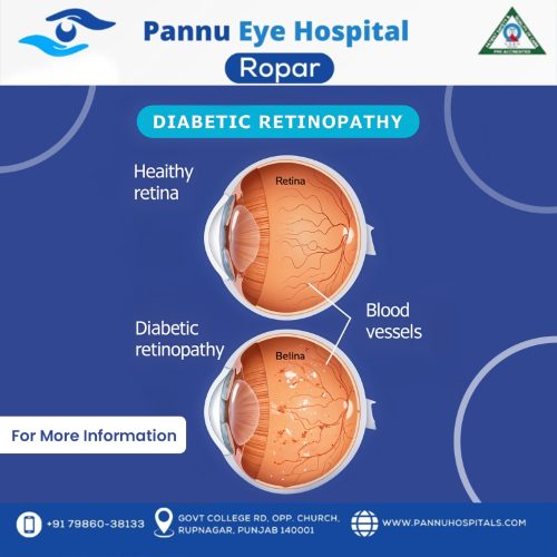 Is Your Retina Health at Risk? Find Out Why Pannu Eye Hospital is the Best!