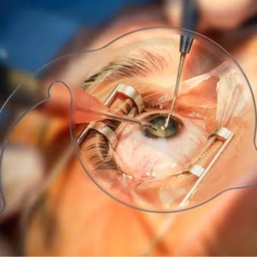 Cataract-Eye-Surgery-new